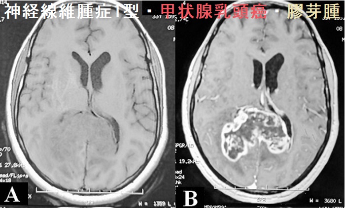 神経線維腫症1型・甲状腺乳頭癌・膠芽腫 造影MRI 神経線維腫症1型・甲状腺乳頭癌・膠芽腫 造影MRI