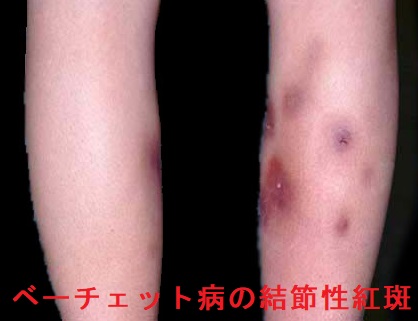 ベーチェット病 結節性紅斑 ベーチェット病 結節性紅斑