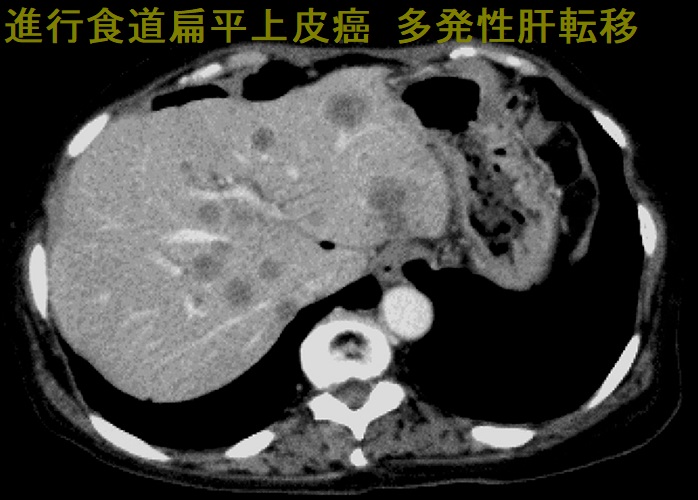 進行食道扁平上皮癌 多発性肝転移 進行食道扁平上皮癌 多発性肝転移