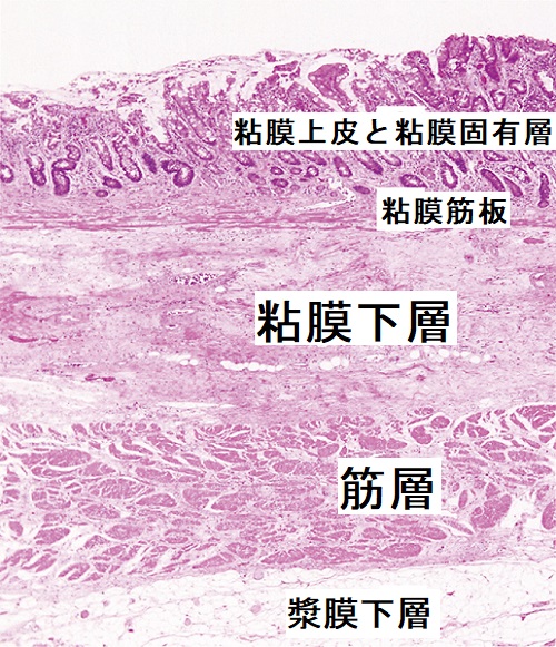 甲状腺と胃がん、KIT(CD117)陽性消化管間質腫瘍[橋本病 バセドウ