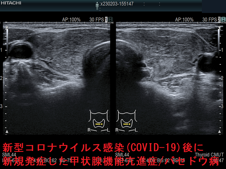 新型コロナウイルス感染(COVID-19)後に新規発症した甲状腺機能亢進症 バセドウ病 超音波(エコー)画像 新型コロナウイルス感染(COVID-19)後に新規発症した甲状腺機能亢進症 バセドウ病 超音波(エコー)画像
