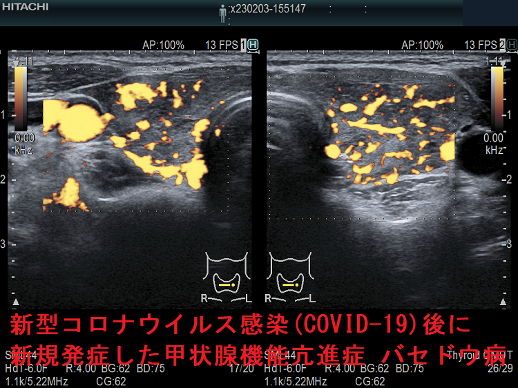 新型コロナウイルス感染(COVID-19)後に新規発症した甲状腺機能亢進症 バセドウ病 超音波(エコー)画像 ドプラーモード 新型コロナウイルス感染(COVID-19)後に新規発症した甲状腺機能亢進症 バセドウ病 超音波(エコー)画像 ドプラーモード