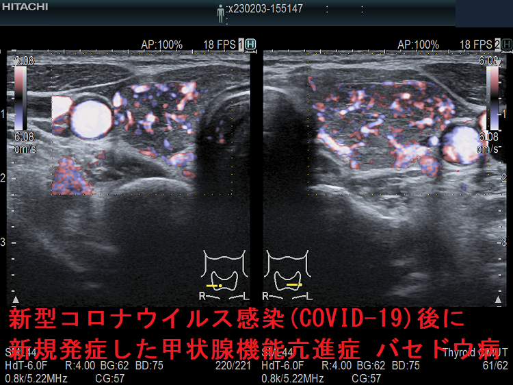 新型コロナウイルス感染(COVID-19)後に新規発症した甲状腺機能亢進症 バセドウ病 超音波(エコー)画像 eFlow(イーフロー) 新型コロナウイルス感染(COVID-19)後に新規発症した甲状腺機能亢進症 バセドウ病 超音波(エコー)画像 eFlow(イーフロー)