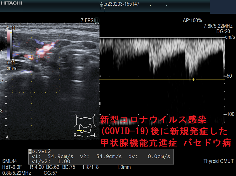 新型コロナウイルス感染(COVID-19)後に新規発症した甲状腺機能亢進症 バセドウ病 超音波(エコー)画像 下甲状腺動脈の収縮期最大血流速度(ITA-PSV) 新型コロナウイルス感染(COVID-19)後に新規発症した甲状腺機能亢進症 バセドウ病 超音波(エコー)画像 下甲状腺動脈の収縮期最大血流速度(ITA-PSV)