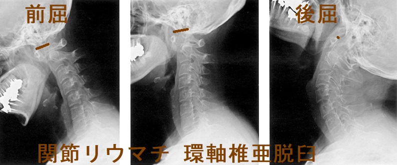 関節リウマチ 環軸椎亜脱臼 関節リウマチ 環軸椎亜脱臼