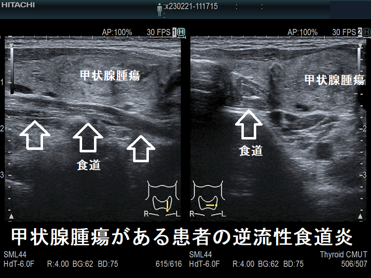 甲状腺腫瘍がある患者の逆流性食道炎 甲状腺腫瘍がある患者の逆流性食道炎