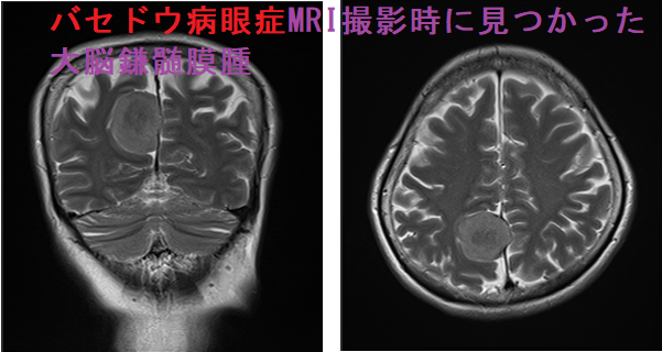 バセドウ病眼症MRI撮影時に見つかった大脳鎌髄膜腫 バセドウ病眼症MRI撮影時に見つかった大脳鎌髄膜腫