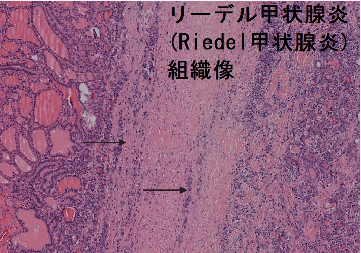 リーデル甲状腺炎(Riedel甲状腺炎)組織像 リーデル甲状腺炎(Riedel甲状腺炎)組織像