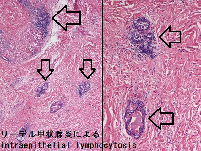 リーデル甲状腺炎によるintraepithelial lymphocytosis (UC, San Diego medpics) リーデル甲状腺炎によるintraepithelial lymphocytosis (UC, San Diego medpics)