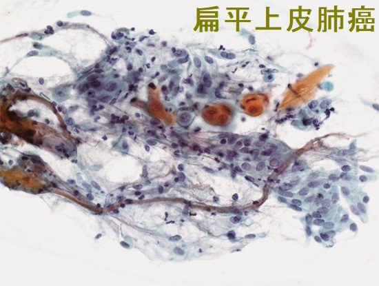 扁平上皮肺癌(末梢肺癌) 気管支鏡下の擦過細胞診 扁平上皮肺癌(末梢肺癌) 気管支鏡下の擦過細胞診