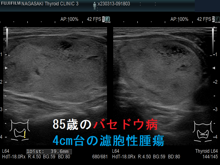 85歳のバセドウ病、4cm台の濾胞性腫瘍 85歳のバセドウ病、4cm台の濾胞性腫瘍