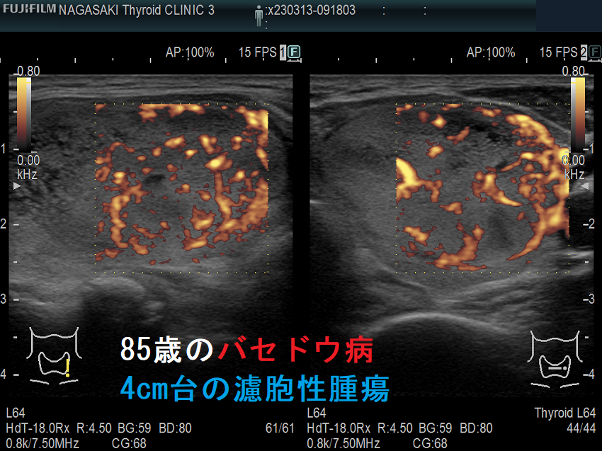85歳のバセドウ病、4cm台の濾胞性腫瘍 ドプラーモード 85歳のバセドウ病、4cm台の濾胞性腫瘍 ドプラーモード