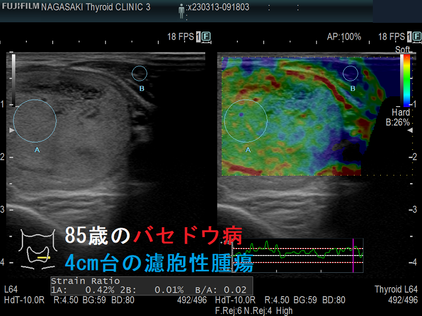 85歳のバセドウ病、4cm台の濾胞性腫瘍 エラストグラフィー 85歳のバセドウ病、4cm台の濾胞性腫瘍 エラストグラフィー