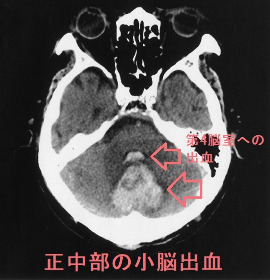 正中部の小脳出血 正中部の小脳出血