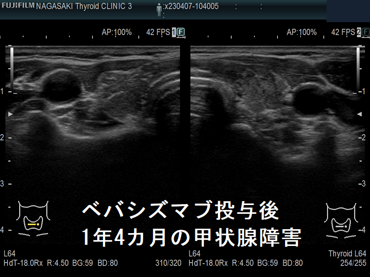 ベバシズマブ投与後1年の甲状腺障害 超音波(エコー)画像 ベバシズマブ投与後1年の甲状腺障害 超音波(エコー)画像