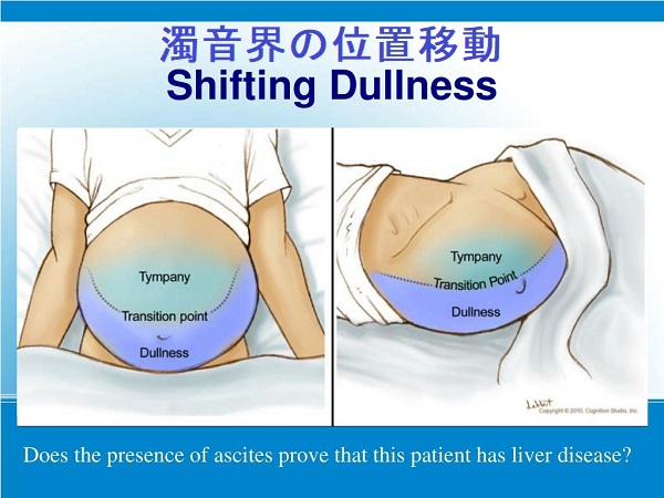 濁音界の位置移動(shifting dullness) 濁音界の位置移動(shifting dullness)