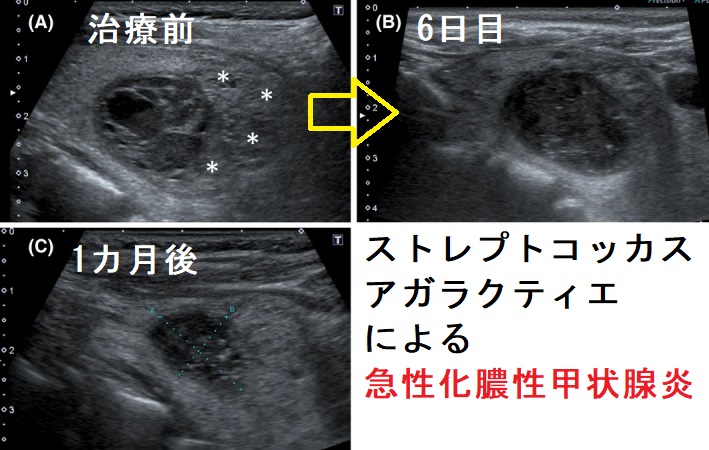 ストレプトコッカスアガラクティエによる急性化膿性甲状腺炎 超音波(エコー)画像 ストレプトコッカスアガラクティエによる急性化膿性甲状腺炎 超音波(エコー)画像