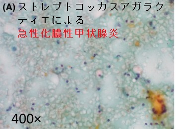 ストレプトコッカスアガラクティエによる急性化膿性甲状腺炎 穿刺細胞診 ストレプトコッカスアガラクティエによる急性化膿性甲状腺炎 穿刺細胞診
