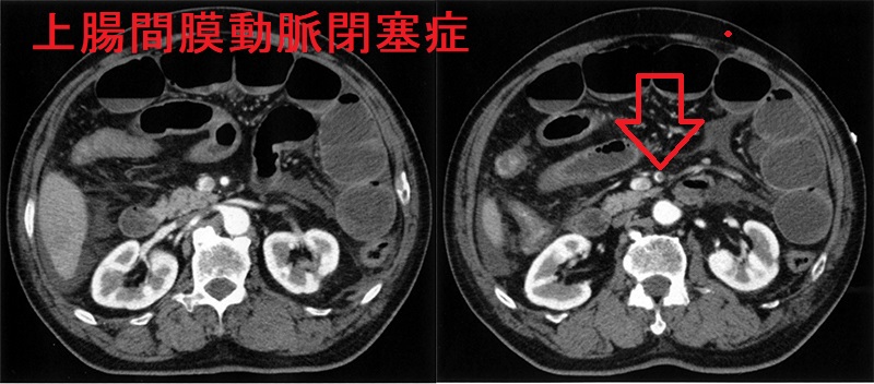 上腸間膜動脈閉塞症 造影CT画像 上腸間膜動脈閉塞症 造影CT画像