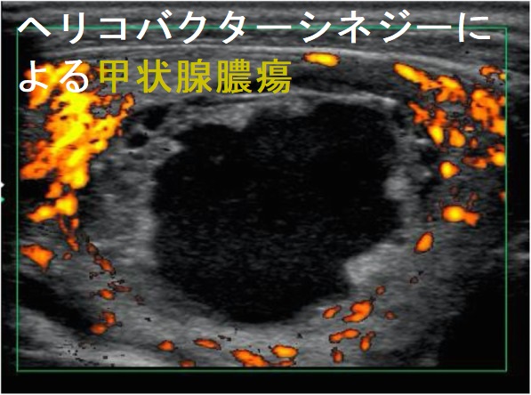 ヘリコバクターシネジーによる甲状腺膿瘍と甲状腺クリーゼ 超音波(エコー)画像 ヘリコバクターシネジーによる甲状腺膿瘍と甲状腺クリーゼ 超音波(エコー)画像