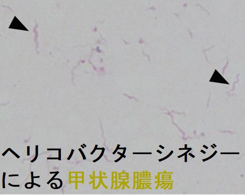 ヘリコバクターシネジーによる甲状腺膿瘍と甲状腺クリーゼ 穿刺液 鏡検 ヘリコバクターシネジーによる甲状腺膿瘍と甲状腺クリーゼ 穿刺液 鏡検