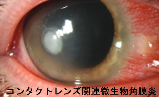 コンタクトレンズ関連微生物角膜炎 コンタクトレンズ関連微生物角膜炎