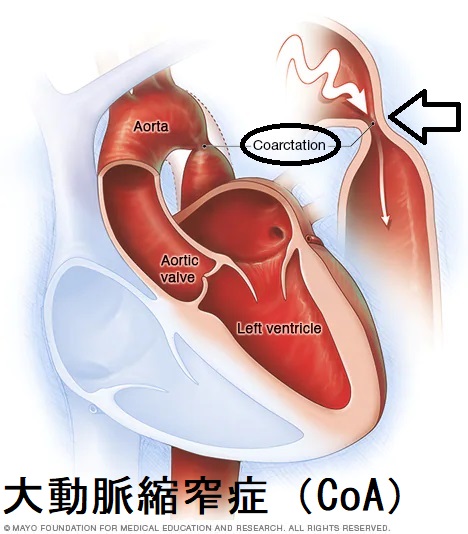 大動脈縮窄症 大動脈縮窄症