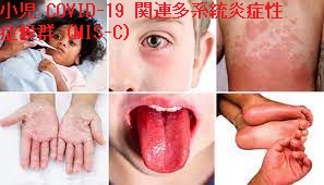 小児 COVID-19 関連多系統炎症性症候群(MIS-C) 小児 COVID-19 関連多系統炎症性症候群(MIS-C)