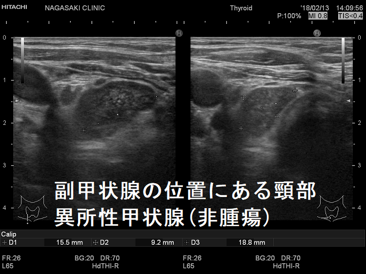 副甲状腺の位置にある頸部異所性甲状腺(非腫瘍) 副甲状腺の位置にある頸部異所性甲状腺(非腫瘍)