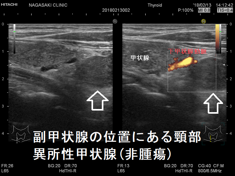 副甲状腺の位置にある頸部異所性甲状腺(非腫瘍)ドプラーモード 副甲状腺の位置にある頸部異所性甲状腺(非腫瘍)ドプラーモード
