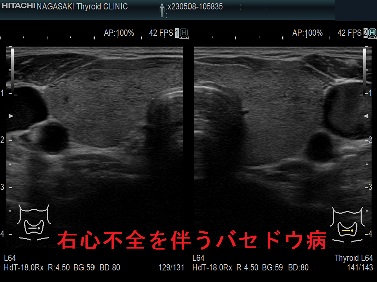 右心不全を伴うバセドウ病 超音波(エコー)画像 右心不全を伴うバセドウ病 超音波(エコー)画像