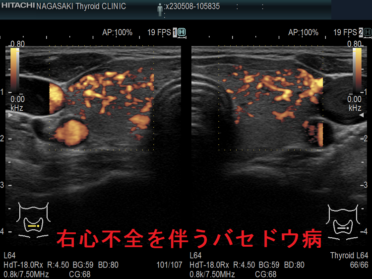 右心不全を伴うバセドウ病 超音波(エコー)画像 ドプラーモード 右心不全を伴うバセドウ病 超音波(エコー)画像 ドプラーモード