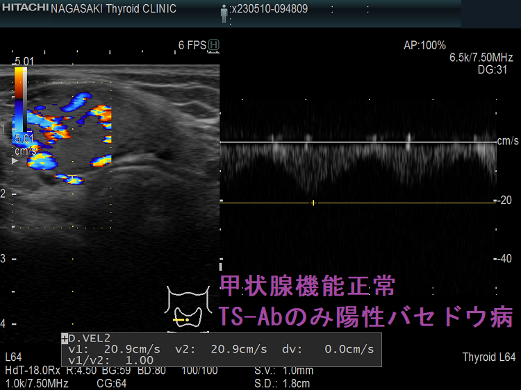 甲状腺機能正常 TSAbのみ陽性バセドウ病 ITA-PSV 甲状腺機能正常 TSAbのみ陽性バセドウ病 ITA-PSV