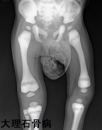 大理石骨病 大理石骨病