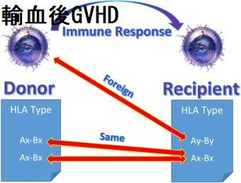 輸血後GVHD 輸血後GVHD