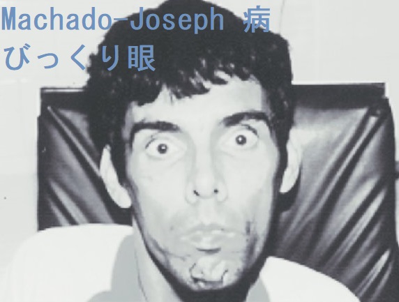 Machado-Joseph 病 びっくり眼 Machado-Joseph 病 びっくり眼