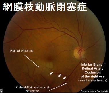 網膜枝動脈閉塞症 網膜枝動脈閉塞症