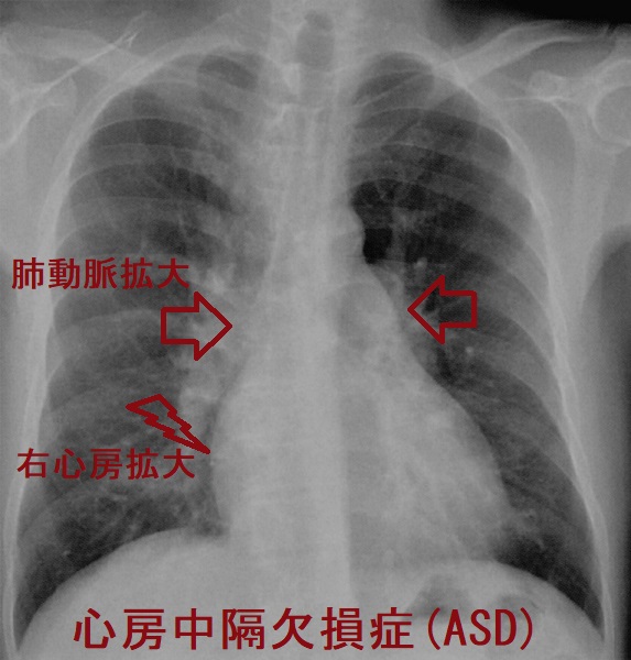心房中隔欠損症(ASD) 胸部エックス線写真 心房中隔欠損症(ASD) 胸部エックス線写真