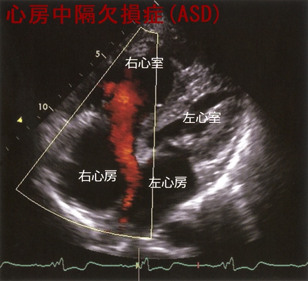 心房中隔欠損症(ASD) 心エコー 心房中隔欠損症(ASD) 心エコー