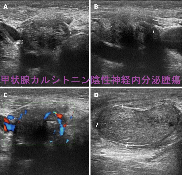 甲状腺カルシトニン陰性神経内分泌腫瘍 超音波(エコー)画像 甲状腺カルシトニン陰性神経内分泌腫瘍 超音波(エコー)画像