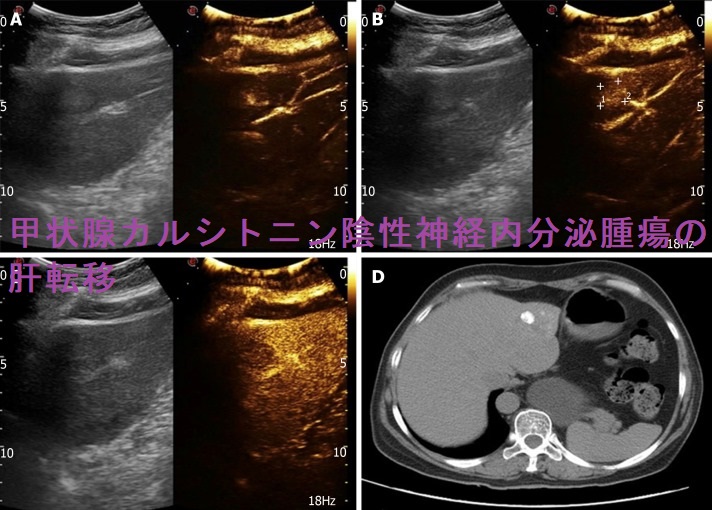 甲状腺カルシトニン陰性神経内分泌腫瘍の肝転移 甲状腺カルシトニン陰性神経内分泌腫瘍の肝転移
