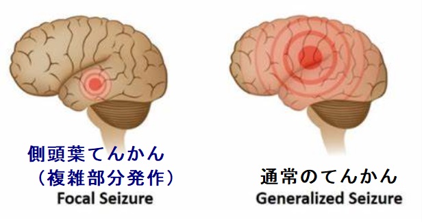 てんかん,てんかん薬(カルバマゼピン等)と甲状腺[甲状腺機能低下