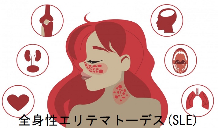 ループス腎炎 ループス腎炎