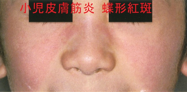 小児皮膚筋炎 蝶形紅斑 小児皮膚筋炎 蝶形紅斑