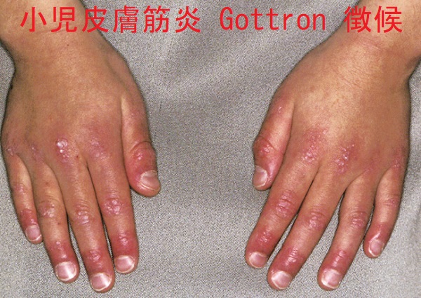 小児皮膚筋炎 Gottron 徴候 小児皮膚筋炎 Gottron 徴候