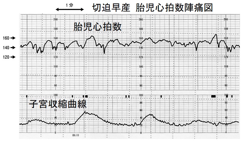 切迫早産 胎児心拍数陣痛図 切迫早産 胎児心拍数陣痛図