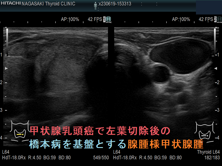 甲状腺乳頭癌で左葉切除後の橋本病を基盤とする腺腫様甲状腺腫 甲状腺乳頭癌で左葉切除後の橋本病を基盤とする腺腫様甲状腺腫