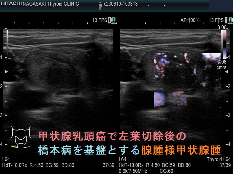 甲状腺乳頭癌で左葉切除後の橋本病を基盤とする腺腫様甲状腺腫 ドプラーモード 甲状腺乳頭癌で左葉切除後の橋本病を基盤とする腺腫様甲状腺腫 ドプラーモード