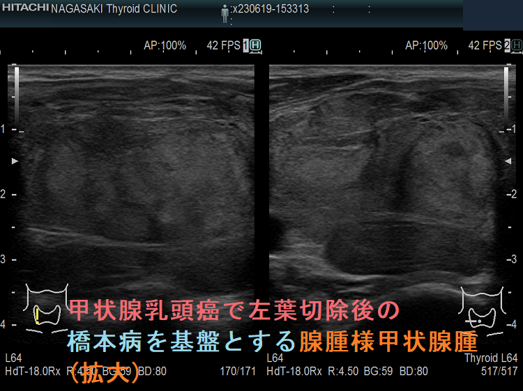 甲状腺乳頭癌で左葉切除後の橋本病を基盤とする腺腫様甲状腺腫(拡大) 甲状腺乳頭癌で左葉切除後の橋本病を基盤とする腺腫様甲状腺腫(拡大)