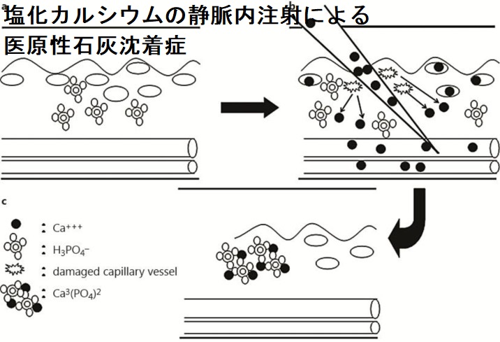 医原性皮膚石灰化症の提案されたメカニズム 医原性皮膚石灰化症の提案されたメカニズム